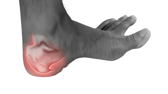 Cure Plantar Fasciitis in One Week