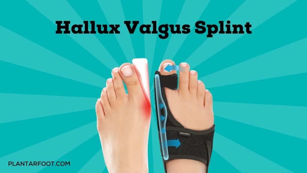 Hallux valgus splint